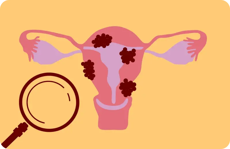Quais os exames para detectar endometriose? Conheça 5!