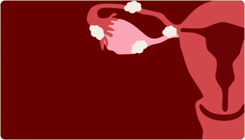 Endometriose: o que é, sintomas e como diagnosticar