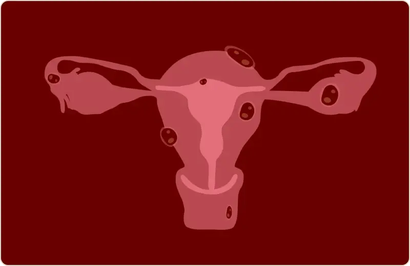 Qual o tratamento para mioma uterino? Preciso de cirurgia?
